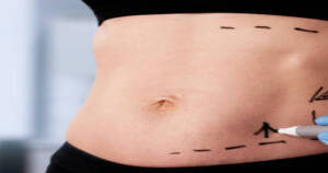 Liposuction in Riyadh